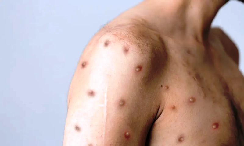 Caso suspeito de Mpox em morador do Paraguai é atendido pelo SUS em Foz
